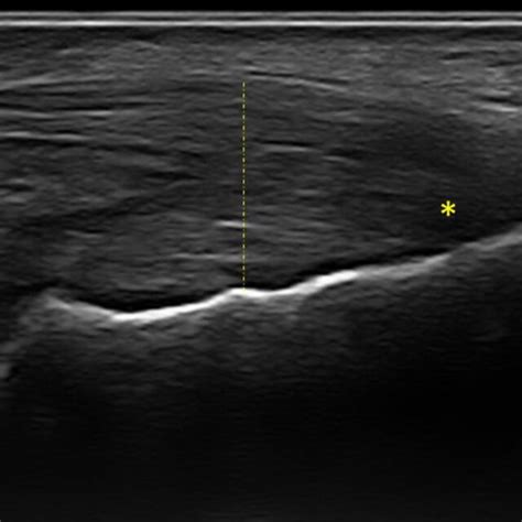 Longitudinal Ultrasound Scan Of Achilles Tendon Omeract Defined Download Scientific Diagram