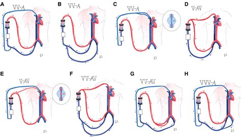 ECMO ExtraCoporial Membrane Oxygenation 네이버 블로그