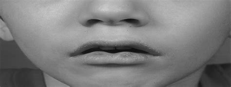 Congenital Lip Pits And Van Der Woude Syndrome Journal Of