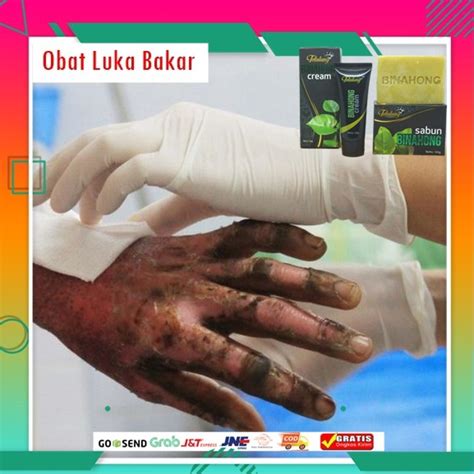 Jual Obat Luka Bakar Obat Bekas Luka Bakar Luka Bakar Melepuh Luka