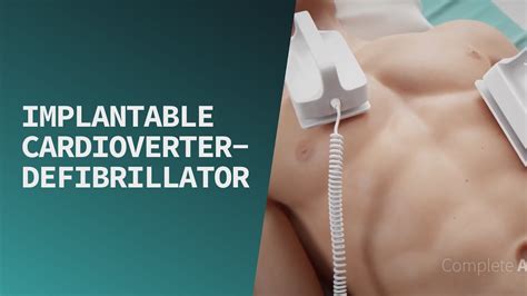 Implantable Cardioverter Defibrillator Youtube