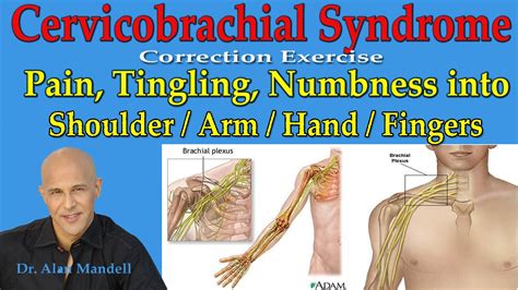 Cervicobrachial Syndrome Corrective Exercise Pain Burning Into