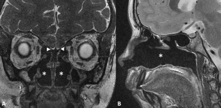 Olfactory Nerve Mri