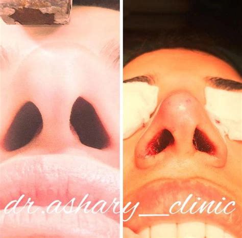 Bulbous Nose Before And After Nose Surgery 2 Rhinoplasty Cost