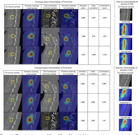 Figure 1 From Enhancing Interpretability Of Vertebrae Fracture Grading