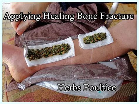 Applying Healing Bone Fracture Herbs Poultice The Homestead Survival