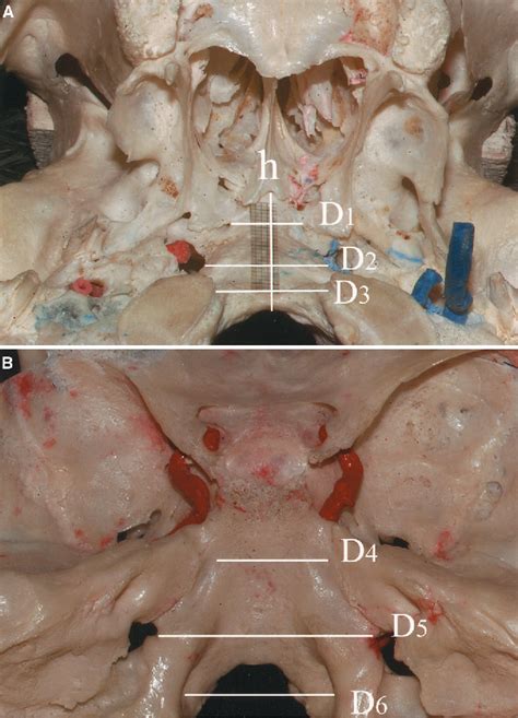 Table From Endoscopic Transoral Transclival Approach To The Brainstem