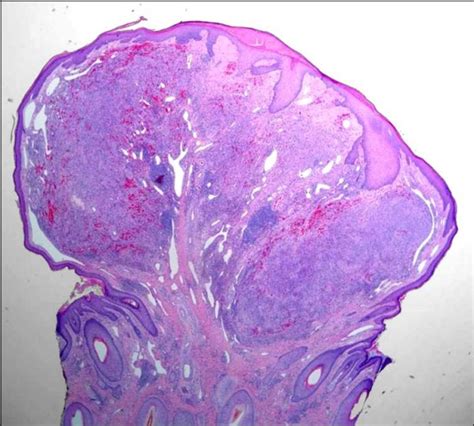 A Completely Regressed Kaposi Sarcoma Lesion Still Retains A Modest