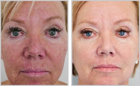 HALO® Laser Skin Resurfacing | Oakville Plastic Surgery – Dr. Nancy de Kleer