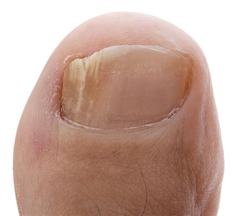 Pseudomonas Nail Infection Causes Symptoms And Best Treatment