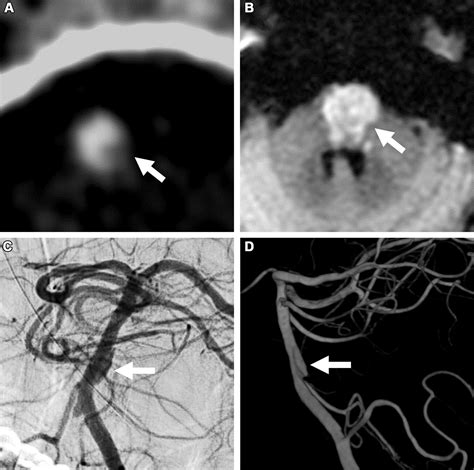 Locked In Syndrome Due To Isolated Basilar Artery Dissection Radiology