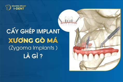 Zygoma Implant Cấy Ghép Implant Xương Gò Má