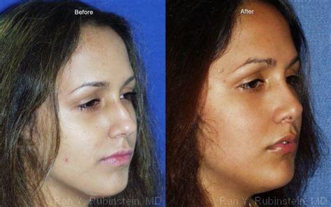 Rhinoplasty Photos Newburgh Ny Patient 13103