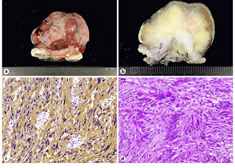 Resected Specimen Analysis A Gross Inspection Revealed A Circumscribed