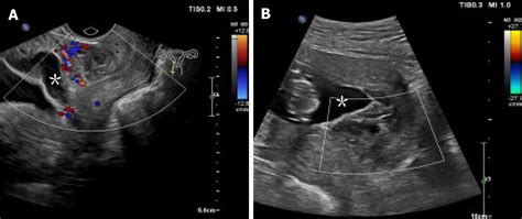 Management Of Heterotopic Cesarean Scar Pregnancy With Preservation Of