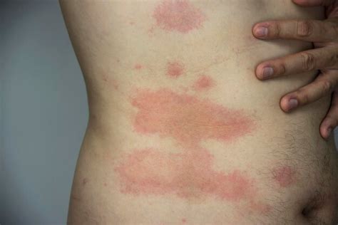 Premium Photo Man Getting Red Skin Rash At His Body Part People With Skin Allergy Problem Concept