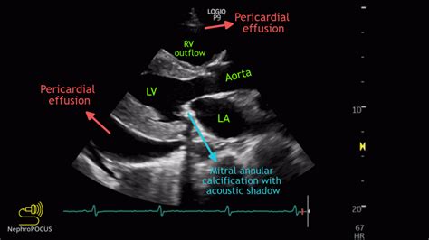 Pericardial Effusion Ultrasound