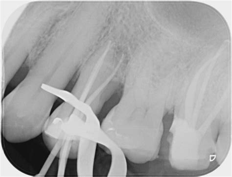 Root Canal Treatment Gallery Before And After Photos London Dentist