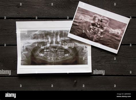 Radiografia Panoramica Immagini E Fotografie Stock Ad Alta Risoluzione