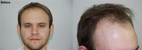 Dr Baubac Hairline Result Dense Packing 3500 Grafts Fue Hair Transplant Hairsite Hair