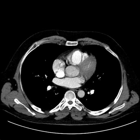 Segmental Pulmonary Embolism Spectral Ctpa Image