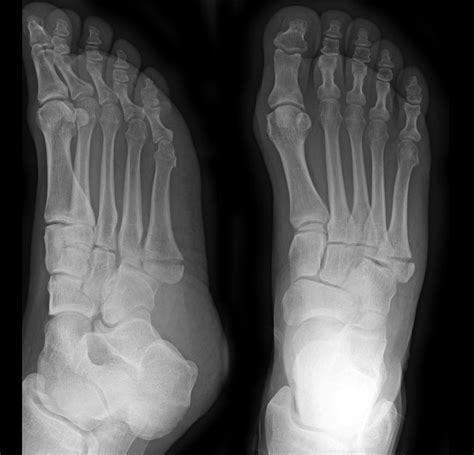 Jones Fractures Core Em