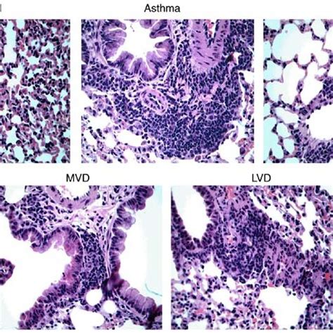 After The Establishment Of Bronchial Asthma Model High H Medium