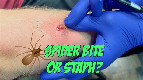 Spider Bite Or Staph New Youtube