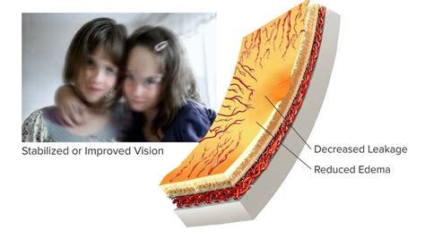 Anti Vegf Treatment Of Diabetic Macular Edema Dme Youtube