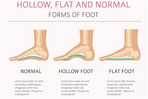 5 Causes Of Flat Feet In Children, Diagnosis, And Treatment