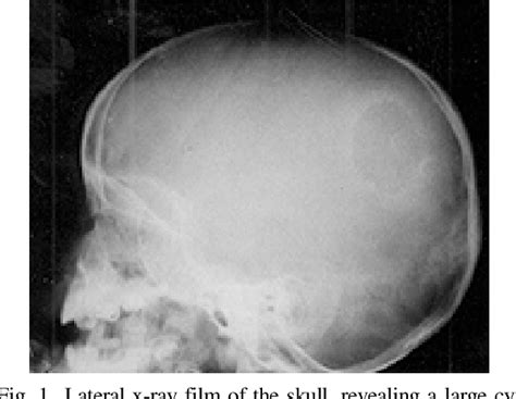 Figure 1 From Intracranial Intraosseous Hydatid Cyst Semantic Scholar