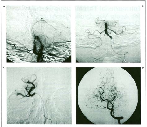 Figure 1 From Intra Arterial Thrombolytic Therapy For Acute Vertebrobasilar Artery Occlusion