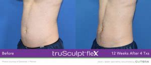 TruSculpt Flex In Miami Body Sculpting Performed By Anti Aging Doctor