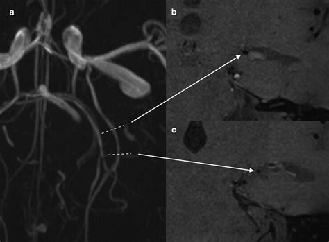 Intracranial Vessel Wall Imaging And Future Directions Radiology Key