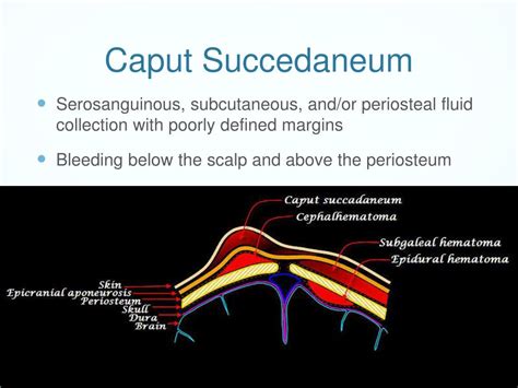 PPT - Cranial Complications in Newborns PowerPoint Presentation, free