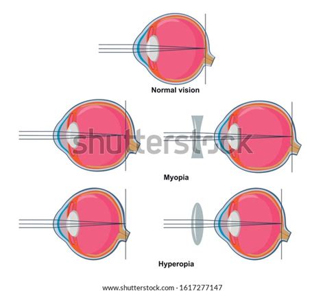 Normal Vision Myopia Hyperopia Stock Vector Royalty Free