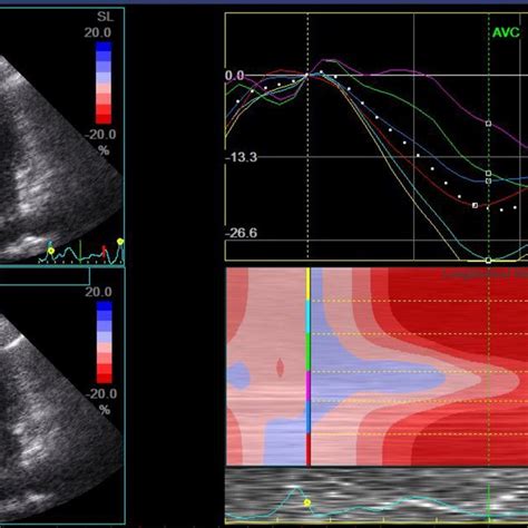 Apical Four Chamber View Of Rv Longitudinal Strain With Download