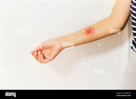 Shingles Zoster Or Herpes Zoster Symptoms On Womans Arm Isolated Stock