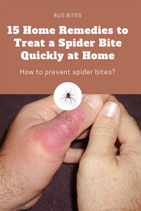 15 Home Remedies To Treat A Spider Bite Quickly At Home Spider Bites Treating Spider Bites