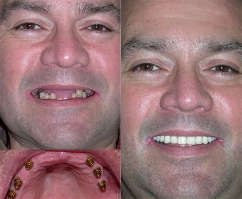 Implant Smile Makeovers Case Astoria Dental Group