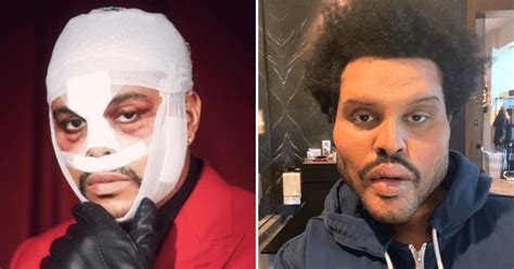 Did The Weeknd Get Plastic Surgery Truth Behind Botox Rumors As Trolls Target Rapper After