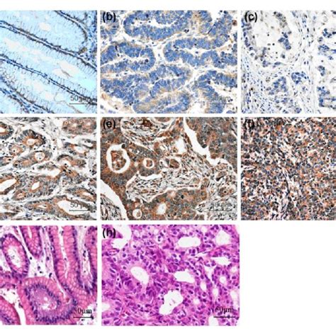 Immunohistochemical And He Staining Of Gankyrin In Gastric Cancer And