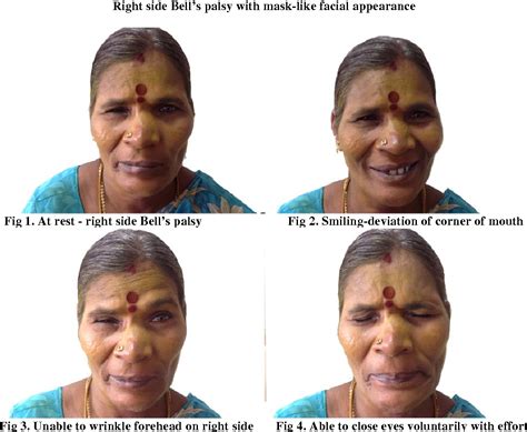 Figure 3 From Facial Palsy A Case Report Semantic Scholar