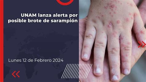 Unam Lanza Alerta Por Posible Brote De Sarampi N Youtube