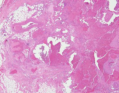 Soft Tissue Tumors of the Mediastinum | Basicmedical Key