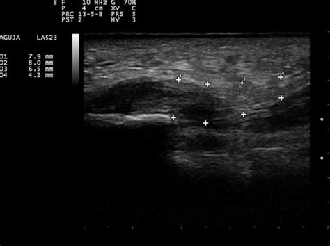 Ultrasound guided Plantar Fasciitis Surgery Clínica del Pie La