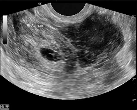 Tubal Ectopic Pregnancy Image