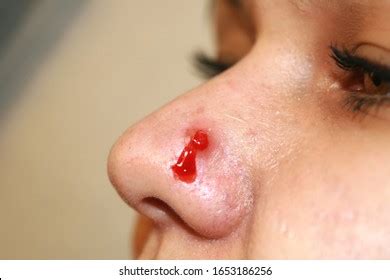 Inflamed Pimple On Nose Cyst Acne Stock Photo 1649904886 Shutterstock