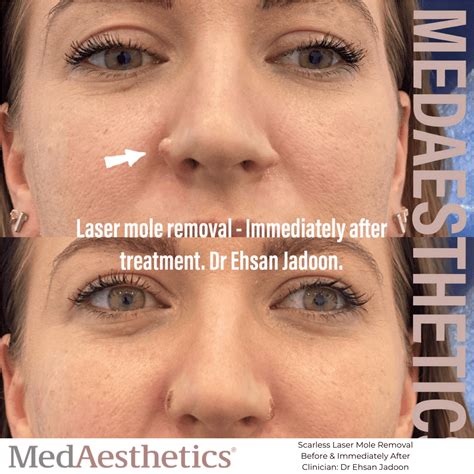 Laser Mole Removal Perth MedAesthetics