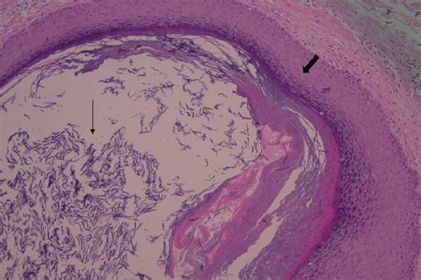 Histopathologic Examination An Epidermoid Cyst Is Lined By A Squamous